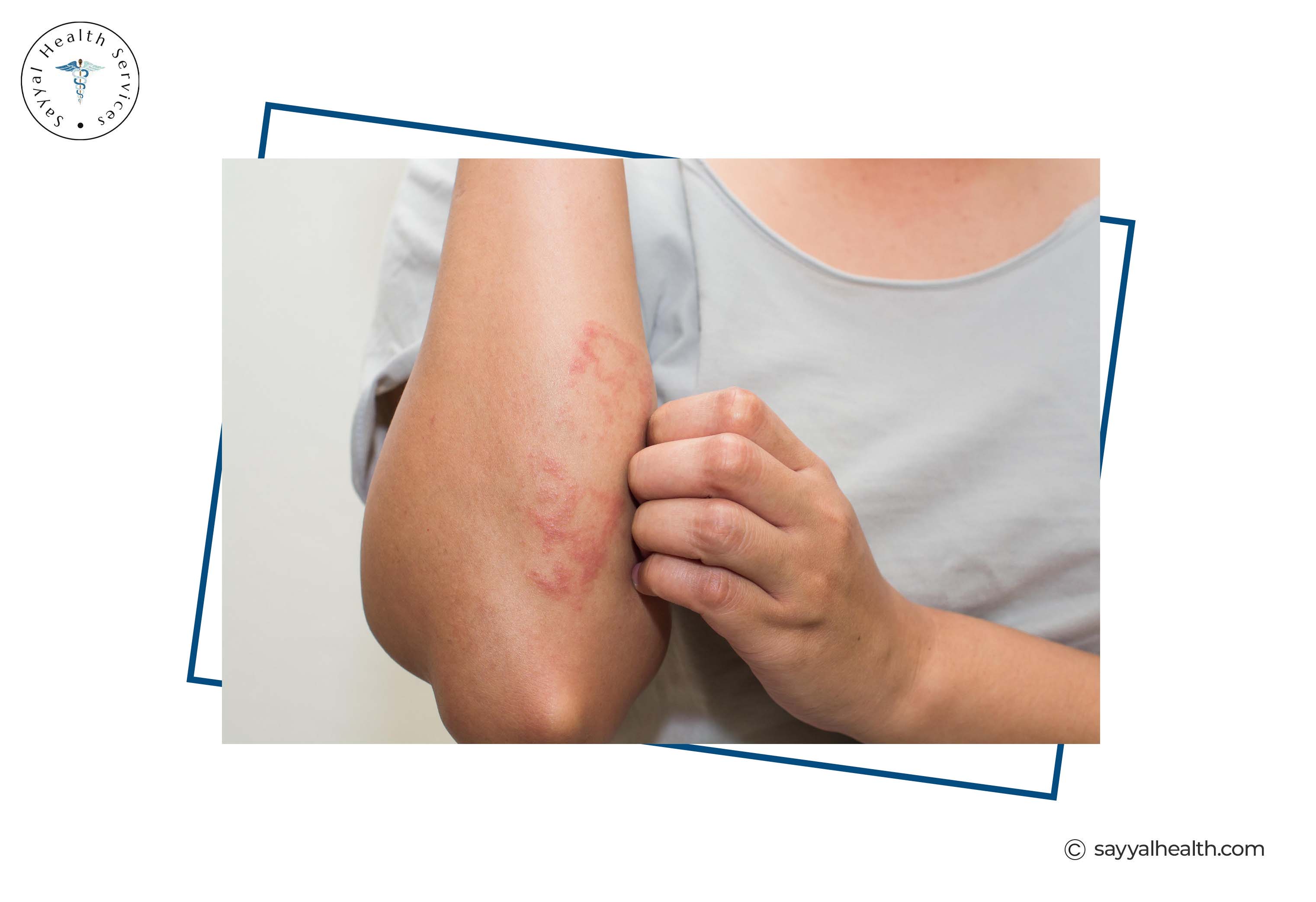 Person scratching red irritated rash on arm